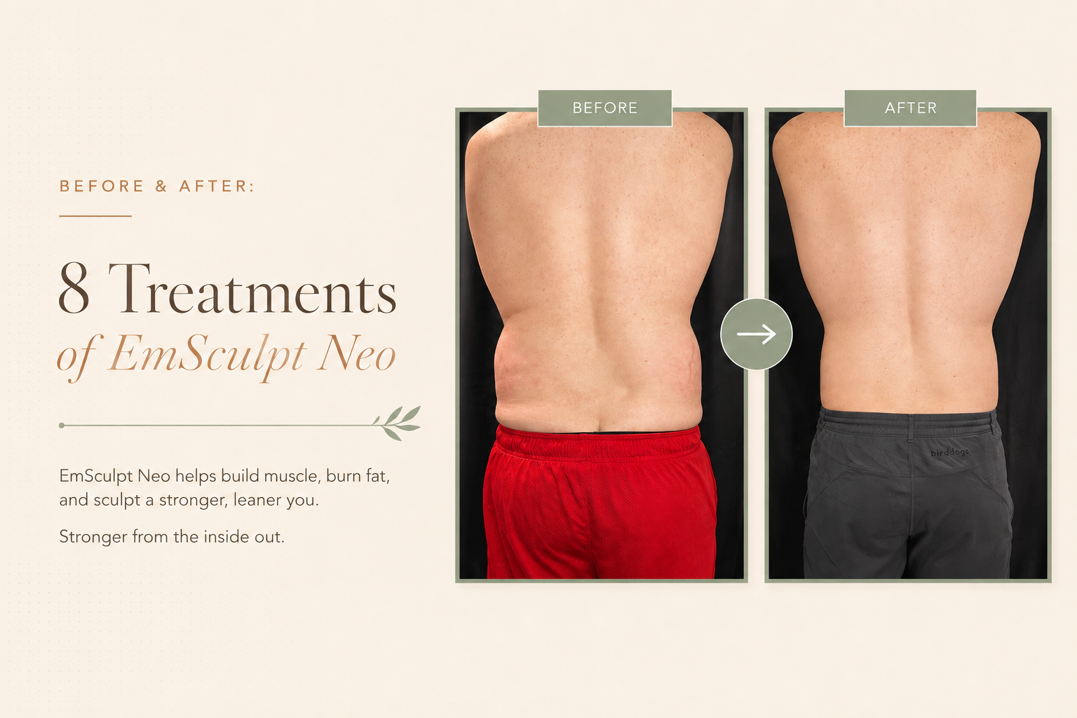 EmSculpt Neo treatment